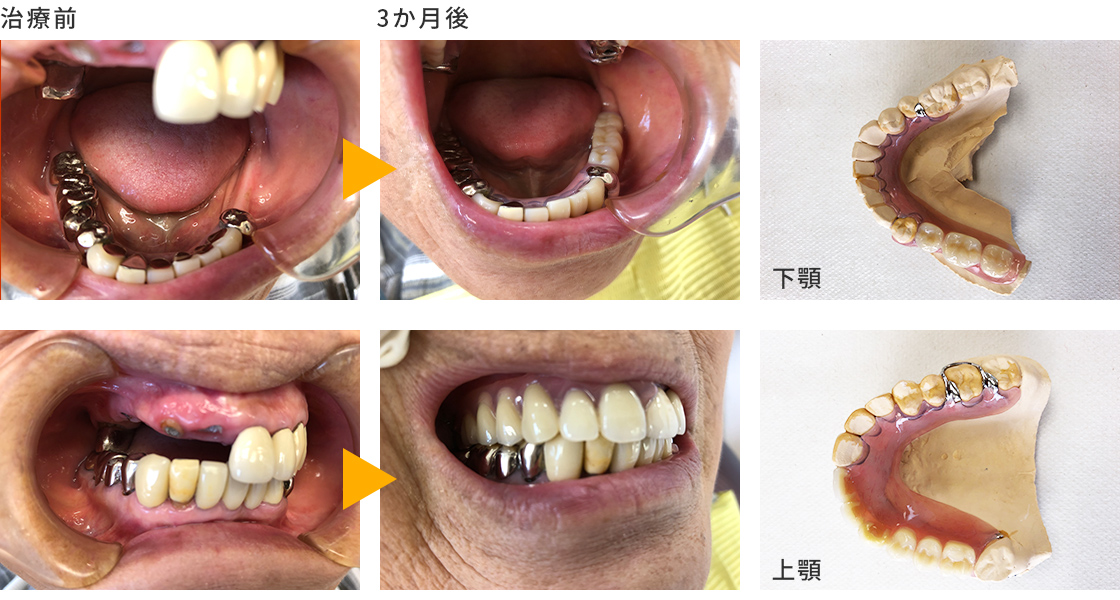 症例③　上下の旧義歯の不具合、バネが見えない入れ歯を希望