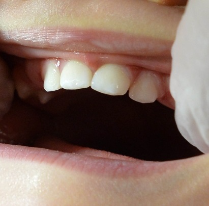 お子さんの歯並びは、早めに治してあげましょう