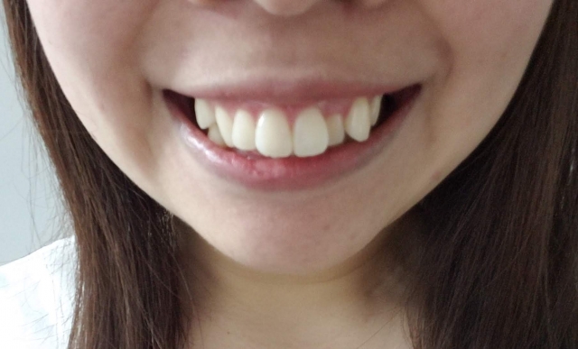 八重歯は部分矯正で改善できる？