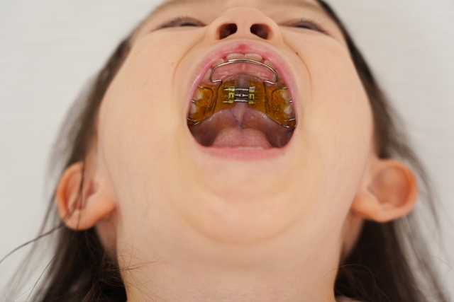 よく聞く「床矯正」って？子どもの歯並びにどのような効果があるの？