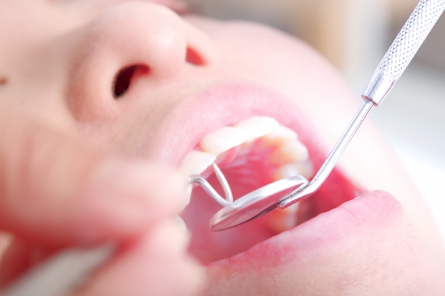 歯石とは？放置するとどうなるの？