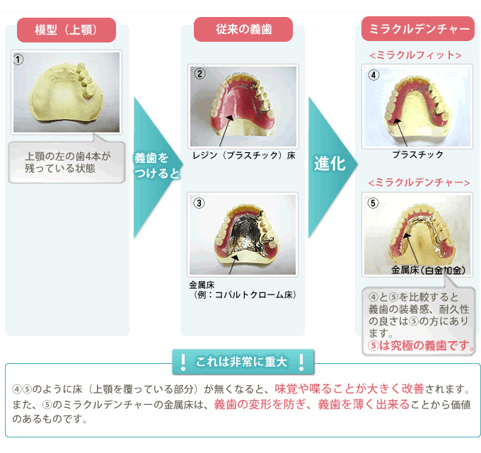 ミラクルデンチャーと従来の義歯との違い
